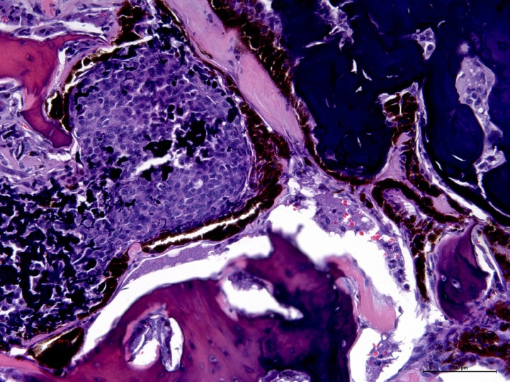 <div class=\"Basic-Text-Frame\">
<p>Histopatología. En la úvea se observan las trabéculas de células neoplásicas dispuestas en paquetes densos y dando lugar a formación de hueso con lagunas óseas y osteocitos evidentes. H&E (x20).</p>
</div>