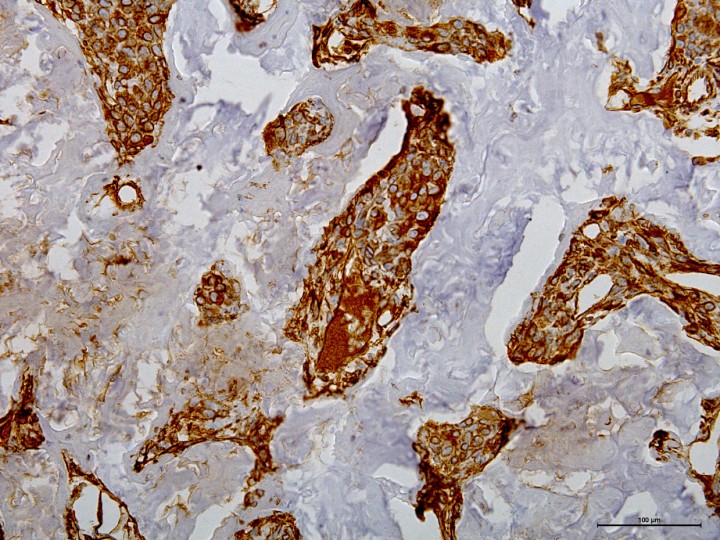 <div class=\"Basic-Text-Frame\">
<p>Histopatología. Trabéculas de células neoplásicas que presentan positividad frente al anticuerpo anti-vimentina. IHQ Vimentina (x20).</p>
</div>