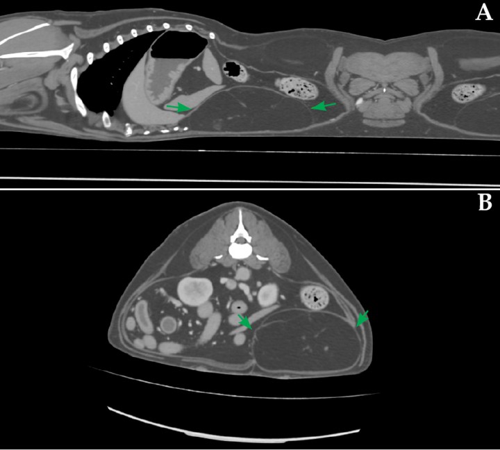 <p>Imagen postcontraste sagital (<strong>A</strong>) y axial (<strong>B</strong>) de TC, en ventana tejido blando, donde se observa una masa ovalada de radiopacidad grasa (flechas) localizada en el flanco izquierdo, entre el músculo oblicuo interno y transverso, y que desplaza algunas vísceras abdominales.</p>