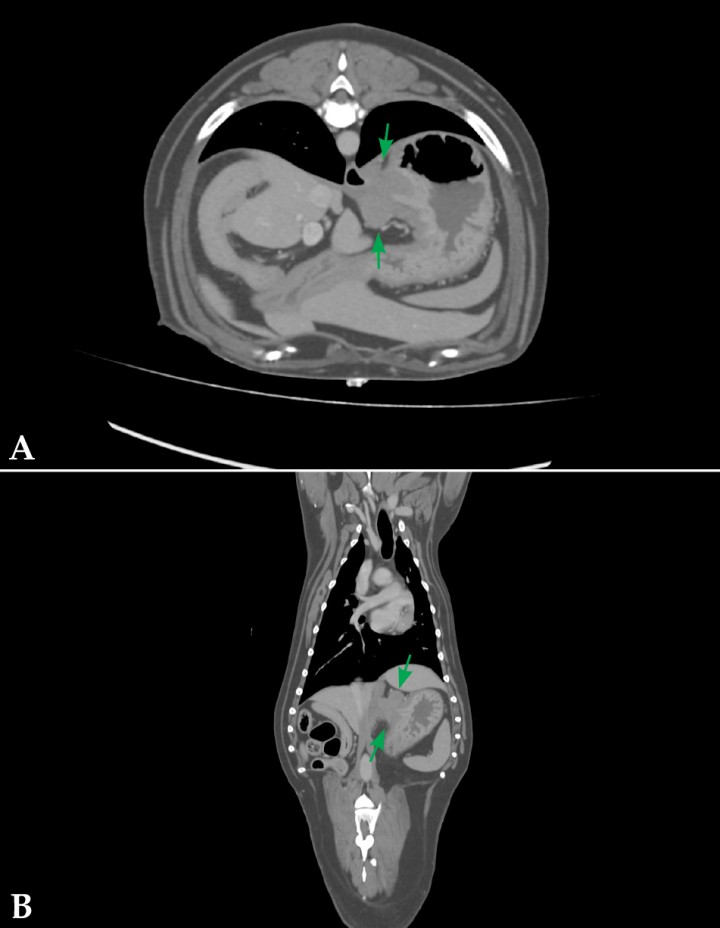 <div class=\"Basic-Text-Frame\">
<p>Imagen postcontraste axial (<strong>A</strong>) y dorsal (<strong>B</strong>) de TC, en ventana tejido blando, donde se observa una masa excéntrica (flechas), bien delimitada, que parte de la capa muscular del estómago, caudal y medial al cardias.</p>
</div>