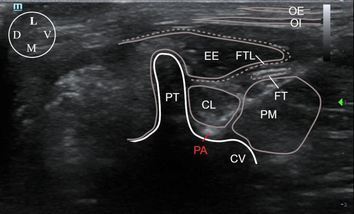 <p>Imagen ecográfica de la aguja con la punta posicionada en el plano dorsal del músculo cuadrado lumbar, adyacente al cuerpo vertebral y proceso transverso de L1. CL: cuadrado lumbar; CV: cuerpo vertebral; D: dorsal; EE: erector espinal; FT: fascia transversal; FTL: fascia toracolumbar; L: lateral; M: medial; OE: oblicuo externo; OI: oblicuo interno; PA: punta de la aguja; PM: psoas menor; PT: proceso transversal; V: ventral.</p>