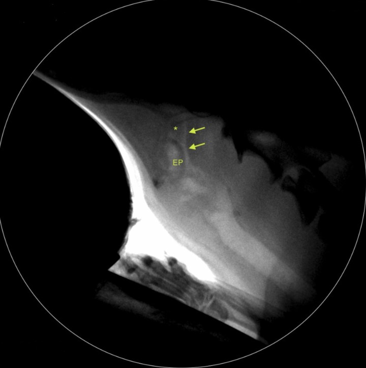 <p>Imagen durante la fluoroscopia en inspiración en la que se evidencia el colapso faringolaríngeo dinámico. Nótese el estrechamiento (flechas) entre el paladar blando (asterisco) y la epiglotis (EP).</p>