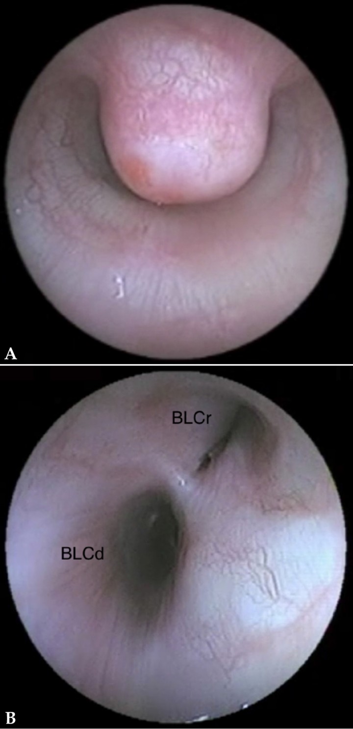 <p>Traqueobroncoscopia. (<strong>A</strong>) Imagen endoscópica de la tráquea en la que se puede observar una masa que ocluye 2/3 del lumen traqueal teniendo su mucosa una superficie lisa y brillante. (<strong>B</strong>) Vista del bronquio principal izquierdo donde se muestra colapso grado 4 (>75 % de la luz) del bronquio lobar craneal (BLCr). BLCd: bronquio lobar caudal.</p>