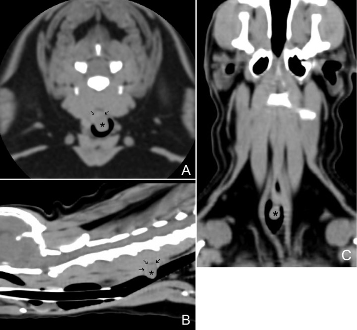 <p>Imágenes de tomografía computarizada (TC) en plano transversal (<strong>A</strong>) y reconstrucciones en planos sagital (<strong>B</strong>) y dorsal (<strong>C</strong>) en ventana de tejidos blandos del cuello del paciente, en las que se puede visualizar una estructura redondeada de atenuación tejido blando (50 UH), de base ancha (asterisco) que protruye hacia el exterior e interior de la luz de la tráquea desde la pared dorsal, a nivel del cuerpo vertebral de C5 (flechas).</p>