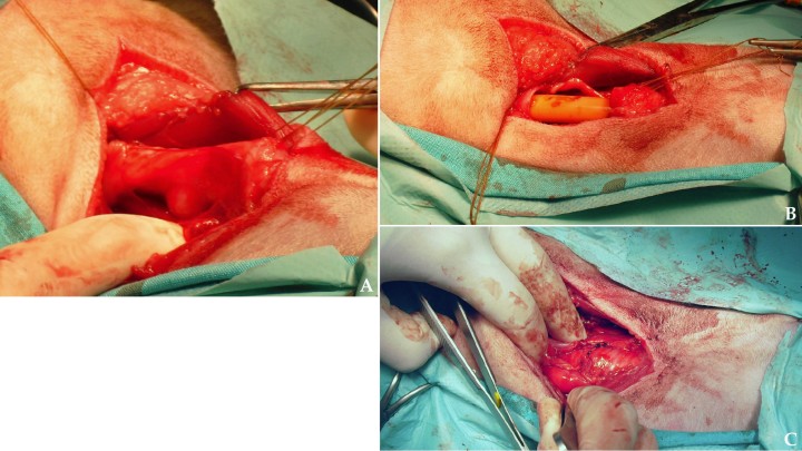 <p>Imágenes intraoperatorias de la traquectomía. (<strong>A</strong>) Se visualiza que, tras la disección del área afectada, el nódulo traqueal hace prominencia también hacia el exterior de la pared traqueal. (<strong>B</strong>) Imagen tras la resección de la zona tumoral tomando dos anillos traqueales sanos a ambos lados. (<strong>C</strong>) Anastomosis termino-terminal con puntos sueltos con material monofilamento reabsorbible.</p>