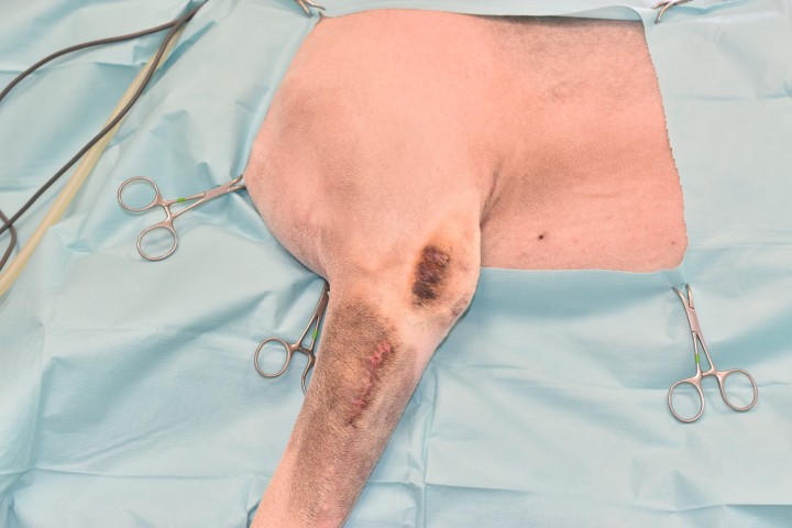 <p>Esta primera imagen muestra la recidiva de un Sarcoma de Tejidos Blandos (STB) tras una escisión incompleta en su centro veterinario habitual. La tasa de recidiva en STB extirpado de forma incompleta oscila entre el 7 % y 20 % si son de grado bajo o intermedio.<sup>1-4</sup> Los STB situados en extremidades son de grado bajo en el 90 % de los casos.<sup>1,2</sup> Como vemos en la imagen, la preparación del paciente incluirá siempre un rasurado y una preparación aséptica extensos, para albergar las opciones reconstructivas locales.</p>
