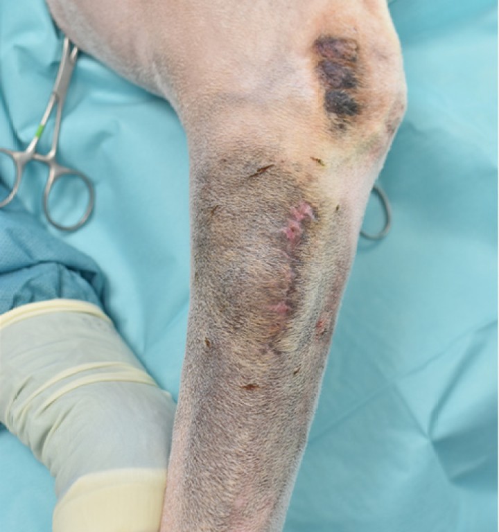 <p>En caso de bordes sucios podemos decidir monitorizar y reevaluar de forma periódica y reintervenir ante la más mínima recidiva, o reintervenir directamente. En caso de reintervención, siempre tomaremos toda la cicatriz como tejido tumoral a partir de la cual deberemos obtener nuestros márgenes laterales y profundos nuevamente. Véase la línea discontinua marcada con bisturí eléctrico monopolar como margen lateral de escisión propuesto. Los márgenes quirúrgicos también se pueden marcar con un rotulador estéril, ya que permite la modificación de estos si es pertinente.</p>