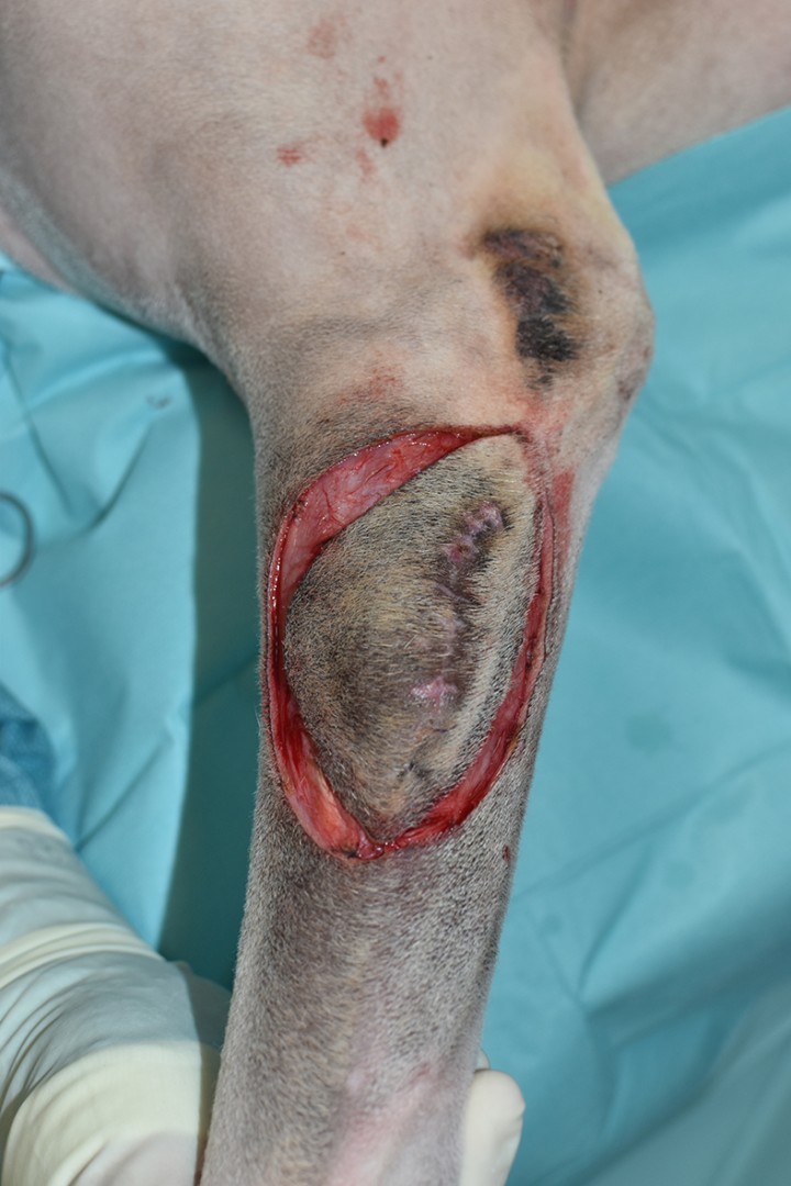 <p>Una vez empezada la escisión deberemos continuar esos márgenes laterales en profundidad, sin perder distancia lateral, hasta encontrar la primera fascia como margen profundo. En este caso, dada la localización lateral en el antebrazo, disponemos de la fascia antebraquial, que no había sido retirada en la cirugía anterior. Cabe destacar la expansión cutánea fisiológica que observaremos durante la escisión, la cual no deberá hacernos errar al transponer esos márgenes laterales en tejidos profundos.</p>