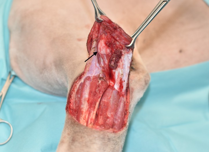 <p>Una vez obtenidos los márgenes laterales circunferencialmente en todas las capas, empezaremos la resección profunda llevándonos la fascia antebraquial, pasando por debajo del tumor y manteniendo el margen profundo intacto. Esta fase es la más importante y demandante de la intervención, ya que es en la que podemos comprometer la funcionalidad de la extremidad y del paciente, así como el éxito de nuestra cirugía oncológica en caso de error. La fascia aporta una barrera fibrosa biológica muy difícil de atravesar por el tumor. Véase como el tumor empuja la fascia antebraquial sin llegar a atravesarla (flecha) así como la resección circunferencial en toda su extensión y la apariencia sana y libre de tumor de los músculos extensores y flexores antebraquiales.</p>