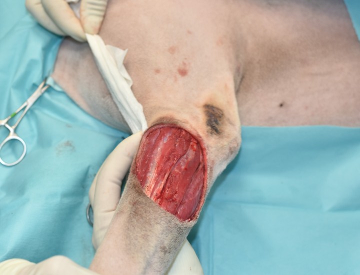 <p>Tras la resección tumoral completa, realizaremos lavados quirúrgicos y valoraremos la necesidad de cambiar la instrumentación, campos y guantes quirúrgicos, antes de empezar la reconstrucción local. Para ello, plantearemos diferentes opciones, siendo elegidas en orden de simplicidad, eficacia y seguridad. Las opciones más complejas podrán ser reservadas cuando no quede más remedio y/o en caso de fallo de una primera intervención.</p>