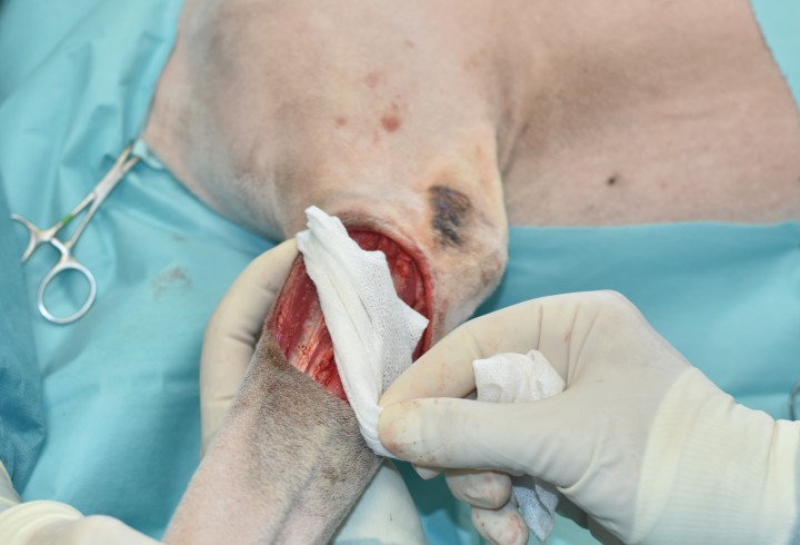 <p>En combinación con la figura anterior vemos una forma de cálculo y translación de un colgajo axial braquial superficial. Los colgajos axiales presentan una arteria directa que los nutre y están previamente determinados en la bibliografía según la disposición característica de la vascularización cutánea en perros y gatos. En general, presentan tasas de supervivencia altas del 70 %-90 % de media según el tipo de colgajo y localización.<sup>5</sup> Su utilidad en reconstrucción siempre debe tenerse en cuenta, ya que permite la movilización de grandes porciones cutáneas o miocutáneas para la reconstrucción de defectos amplios con tasas de éxito generalmente altas. Se recomienda comprobar la buena funcionalidad y localización de la arteria mediante Doppler antes de realizar la cirugía.</p>