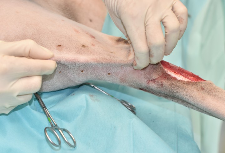 <p>La amplitud del colgajo está igualmente determinada por las guías; sin embargo, en veterinaria existe una gran variabilidad individual, por lo que comprobar la laxitud cutánea en cada caso previamente a la obtención de colgajos o injertos es fundamental para evitar sorpresas desagradables. Una vez calculada la longitud y amplitud de nuestro colgajo, evaluaremos las opciones de transposición, en la mayoría de los casos realizando una incisión puente o un túnel cutáneo para permitir la llegada del colgajo a la zona a reconstruir. Los colgajos pueden quedar anclados únicamente por su pedículo vascular, siendo la piel de la base cortada para permitir una rotación mayor (aunque esto puede aumentar el riesgo de oclusión vascular), denominándose insulares. El peninsular es el más conocido donde tanto el pedículo vascular como la base se mantienen intactos (como en las imágenes).</p>