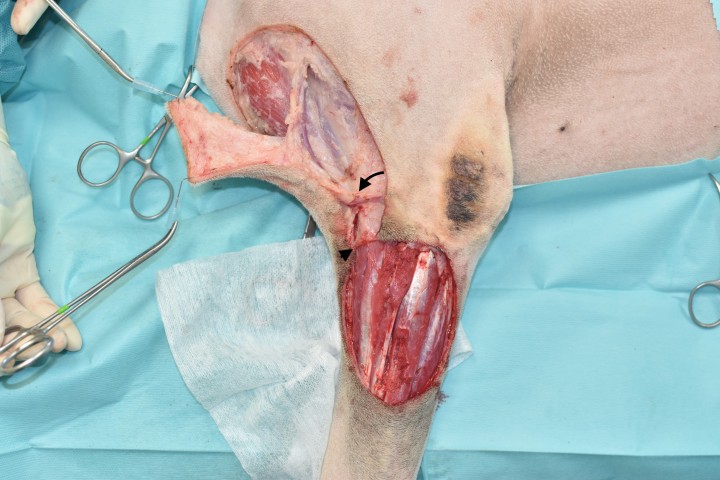 <p>La obtención del colgajo es un proceso fundamental, pues dependemos de ello para que nuestra reconstrucción tenga éxito. La vascularización directa siempre deberá mantenerse en el colgajo como se muestra en la imagen (flecha). Además, procuraremos una manipulación mínima, en la mayoría de ocasiones con suturas de tracción o ganchos. La región de rotación normalmente coincidirá con la región de salida de nuestra arteria directa. Cuidaremos que durante ese proceso la vascularización no sufra daños ni colapsos, siendo normalmente menor a 180º en casos peninsulares y ligeramente superior en insulares. En nuestro caso, se ha realizado una incisión puente (cabeza de flecha) para permitir la continuidad en la aposición del colgajo.</p>