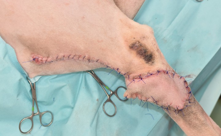 <p>Finalmente, para evitar complicaciones, prestaremos una gran atención a la realización de una capa subcutánea/subcuticular en nuestra reconstrucción, ya que liberará la tensión directa sobre la piel. Se recomienda siempre evaluar la funcionalidad de la región y movilidad de la extremidad asociada a la tensión resultante de cada movimiento. En el colgajo, trataremos de realizar suturas discontinuas, ya que estas permitirán mejor distribución de tensiones, dehiscencia parcial y drenaje si fuera necesario sin afectar a toda la sutura. Valoraremos la idoneidad de los vendajes protectores, ya que en ocasiones pueden penalizar la vascularización local debido a la compresión.</p>