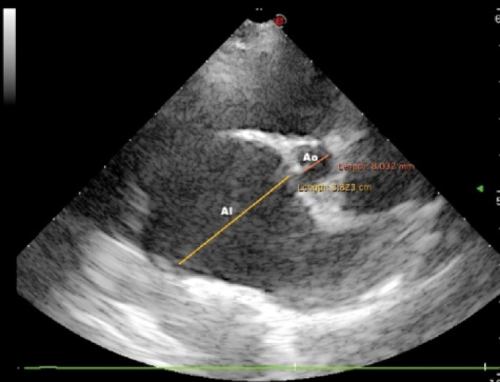 <p>Imagen ecocardiográfica paraesternal derecha en eje corto a la altura de la base cardiaca en la que se observa un aumento del ratio atrio izquierdo/aorta (AI/Ao= 4,76; normal <1,6). AI: atrio izquierdo; Ao: Aorta.</p>