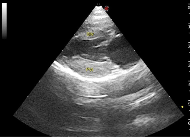 <p>Imagen ecocardiográfica paraesternal derecha en eje largo cuatro cámaras de un gato con cardiomiopatía hipertrófica. En la imagen se observa engrosamiento de la pared libre del ventrículo izquierdo (PVI) (0,81 cm) y del septo interventricular (SIV) (0,73 cm). Valores > 0,6 cm son sugestivos de CMH.</p>