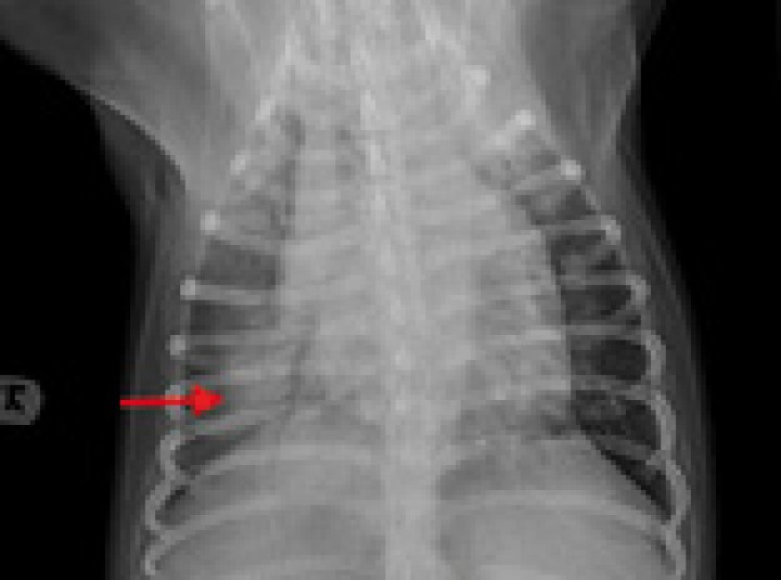 <p>Radiografía dorsoventral de tórax de un perro con fallo cardiaco congestivo secundario a una cardiomiopatía dilatada. Se observa cardiomegalia y patrón alveolar en el lóbulo caudal derecho compatible con edema pulmonar de origen cardiogénico (flecha roja).</p>