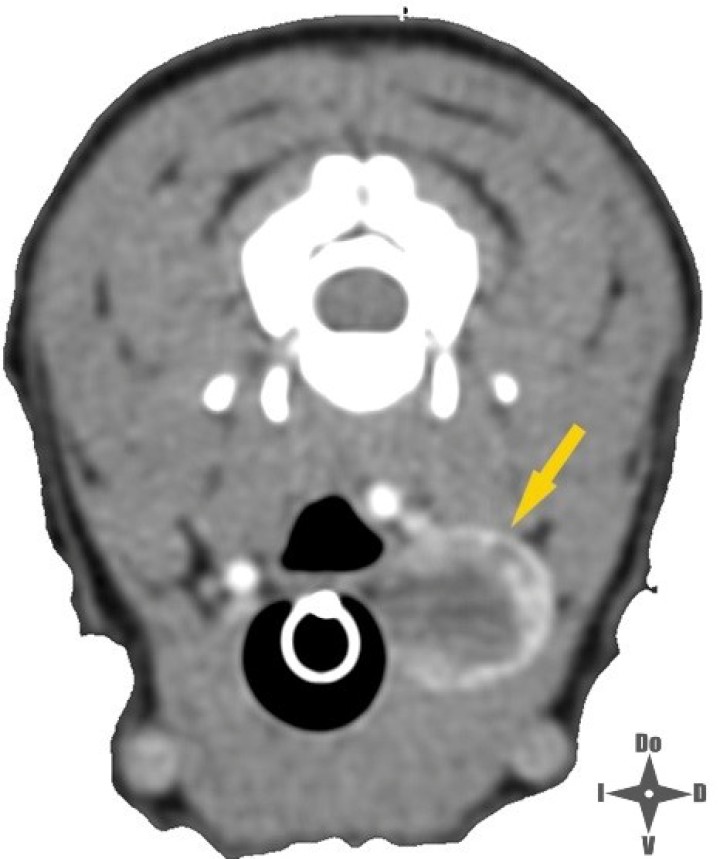 <p>Imagen de TC con contraste IV; la fecha amarilla señala la neoplasia.</p>