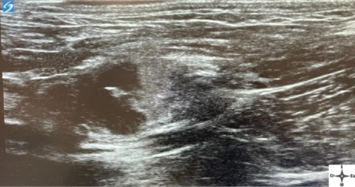 <p>Ventana acústica observando la neoplasia cavitada previamente a la inyección del anestésico local con contraste iodado.</p>