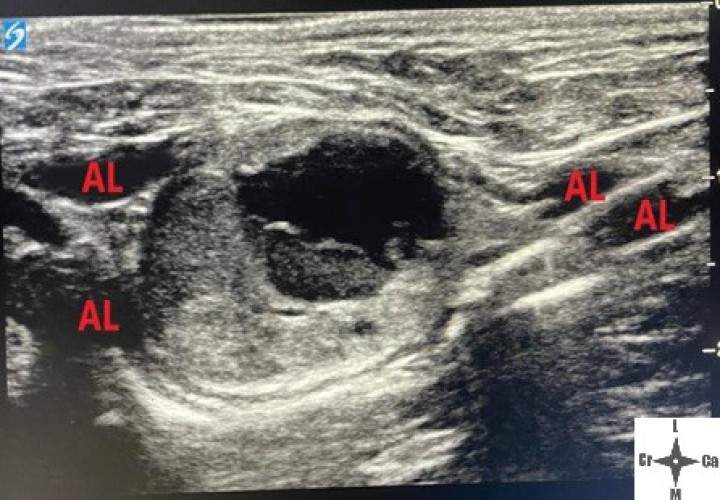 <p>Ventana acústica observando la neoplasia cavitada y la distribución del volumen inyectado (AL).</p>
