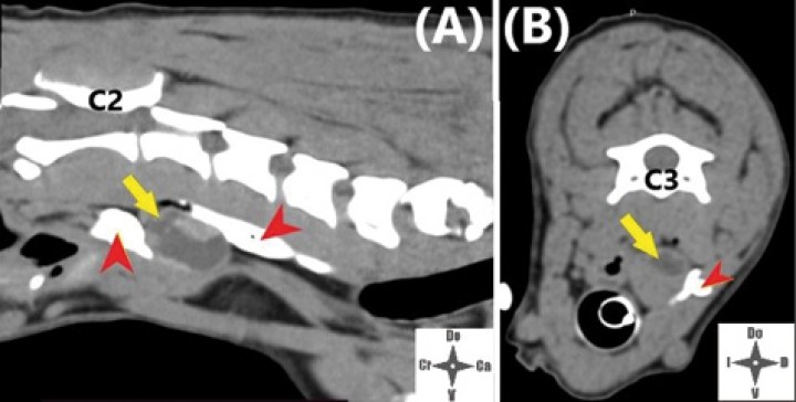 <p>Imágenes de TC post-inyección. (<strong>A</strong>) Corte sagital. (<strong>B</strong>) Corte axial. La flecha amarilla marca la neoplasia y las cabezas de flecha rojas el contraste en el espacio interfascial.</p>