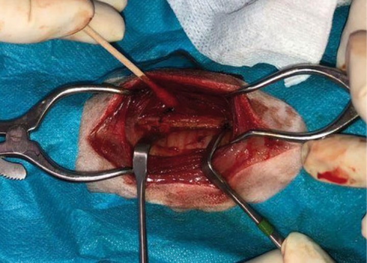 <p>Abordaje quirúrgico de la región previa a exponer la neoplasia.</p>