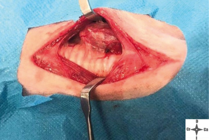 <p>Imagen de la neoplasia durante el abordaje quirúrgico.</p>