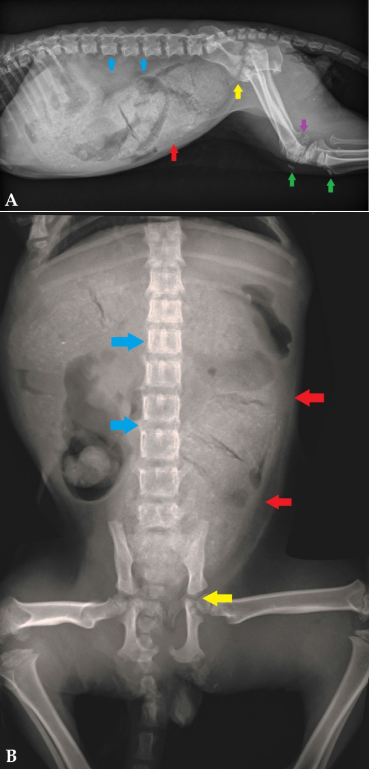 <p>Mismas radiografías que en la Figura 1. Imagen compatible con megacolon y retención fecal grave ocupando gran parte del abdomen (flechas rojas). Se observa retraso en el cierre de los cartílagos de crecimiento vertebrales y las epífisis vertebrales se encuentran disminuidas de tamaño y con menor grado de osificación (flechas azules). Puede apreciarse disgenesia epifisaria de los cóndilos femorales y tibiales (flecha morada), hipoplasia de la tuberosidad tibial y de la rótula (flecha verde) y cierre incompleto de la pelvis (flecha amarilla).</p>