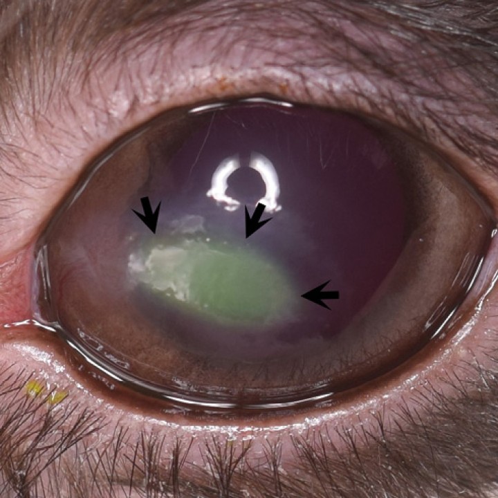 <p><strong>Úlcera corneal indolente</strong>. La siguiente fotografía corresponde al ojo de un conejo. En este tipo de úlceras los márgenes del epitelio no están adheridos a su membrana basal, pudiendo observarse un patrón de tinción con fluoresceína en forma de halo, menos intenso alrededor del defecto, ya que la fluoresceína discurre por debajo del epitelio no adherido y esta se observa a través del mismo (flechas). El tratamiento consiste en desbridar el epitelio no adherido con la ayuda de un bastoncillo de algodón estéril, previa instilación de colirio anestésico. El desbridamiento con <em>diamond burr </em>también está indicado en este tipo de úlceras, aunque debe realizarse con precaución, ya que la córnea del conejo es más delgada que la de la especie canina. El uso de lentillas de contacto está indicado como protección corneal durante el proceso de cicatrización.</p>