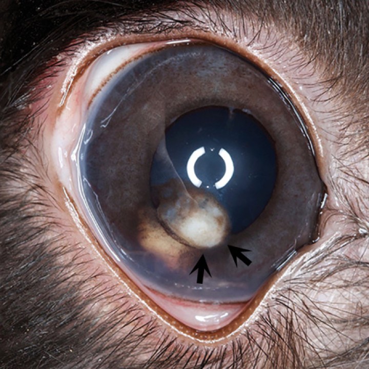 <p><strong>Uveítis anterior y cataratas</strong>. En la fotografía podemos observar el ojo de un conejo que presenta una catarata capsular anterior con un granuloma de color blanco-pálido a rosado en la superficie del iris (flechas). Con esta presentación los diferenciales a incluir serían infecciones por <em>Encephalitozoon cuniculi</em>, <em>Pasteurella</em> sp. o <em>Staphylococcus</em> sp. En el presente caso después de realizar las pruebas necesarias, el diagnóstico definitivo fue una infección por <em>Encephalitozoon cuniculi</em>. En estos casos frecuentemente observamos también una uveítis anterior secundaria, en la cual podemos observar efecto Tyndall, miosis o rubeosis iridis. El tratamiento empírico con corticoesteroides tópicos y AINEs sistémicos puede controlar el proceso inflamatorio; no obstante, identificar la causa para aplicar un tratamiento específico es fundamental. El uso de fenbendazol oral está indicado en los casos que se sospeche de <em>E. cuniculi</em>. La escisión quirúrgica de la catarata mediante facoemulsificación junto con la implantación de una lente intraocular es el tratamiento de elección para preservar la visión de los pacientes afectados (Imagen cedida por Dr. Ángel Ortillés).</p>