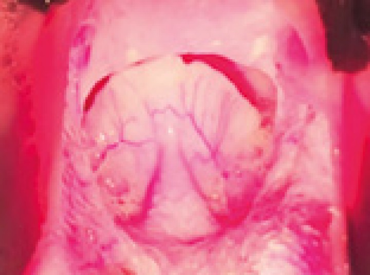<p>Detalle de retroversión epiglótica de alto grado (retroflexión de la epiglotis en fase de inspiración con obstrucción completa de la <em>rima glottidis</em>).</p>