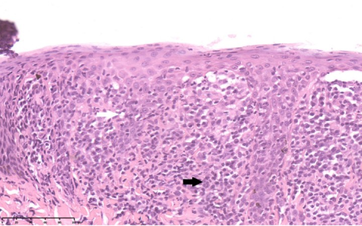 <p>Linfoma epiteliotrópico en unión mucocutánea. Infiltración linfoide neoplásica en dermis superficial (flecha negra) y mostrando comportamiento epiteliotrópico (flecha blanca) (tinción hematoxilina-eosina, 30 x).</p>