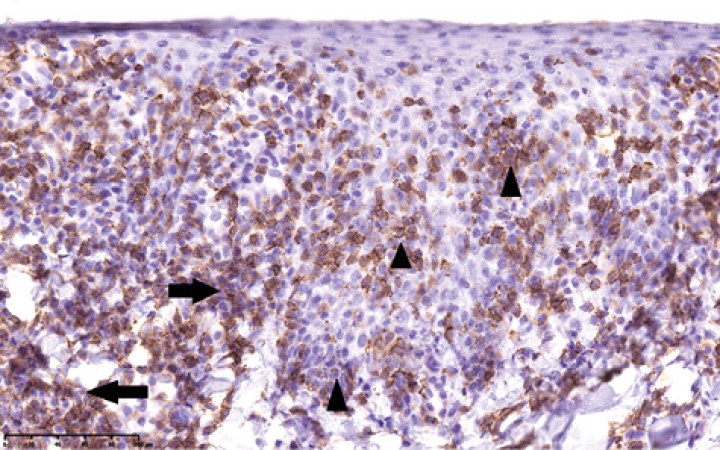 <p>Linfoma epiteliotrópico en unión mucocutánea. Células neoplásicas de imagen anterior (Fig. 2) mostrando tinción positiva a CD3, infiltrando dermis superficial (flecha negra) y mostrando comportamiento epiteliotrópico (puntas de flecha negras) (tinción de linfocitos T mediante técnica inmunohistoquímica con anticuerpo anti-CD3 y contraste con hematoxilina, 30 x).</p>