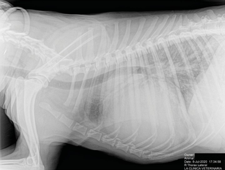 <p>Radiografía lateral de tórax en la que se observa cardiomegalia generalizada, VHS 15. Patrón alveolar intersticial compatible con edema pulmonar. Patrón vascular mixto y patrón bronquial en lóbulos caudales, compatible con bronquitis crónica, mineralización por degeneración senil.</p>