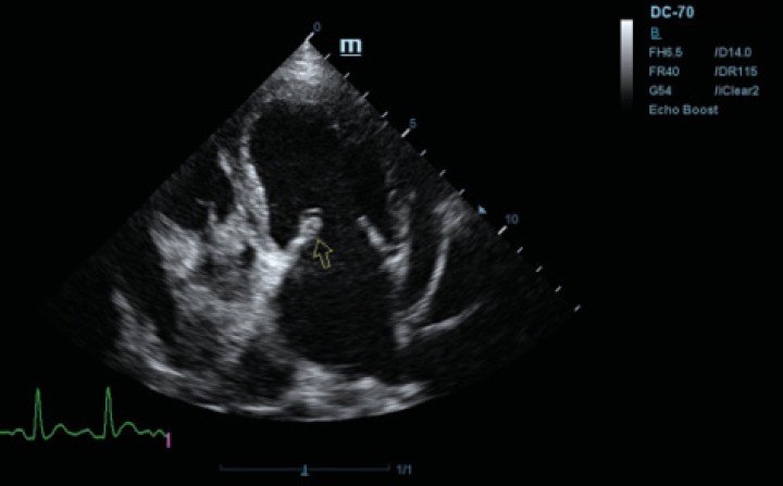 <p>Ecocardiografía en corte paraesternal izquierdo eje largo, de 4 cámaras en la que se observa engrosamiento de la válvula mitral (flecha).</p>