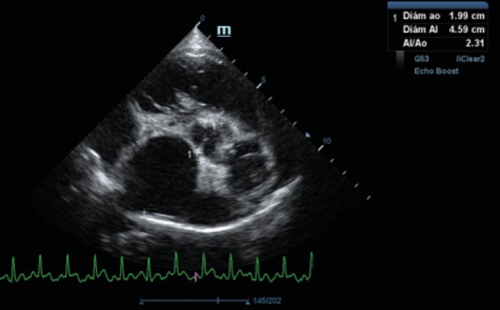 <p>Ecocardiografía en corte paraesternal derecho eje corto en base de corazón, visualizando ratio atrio izquierdo/aorta aumentado.</p>