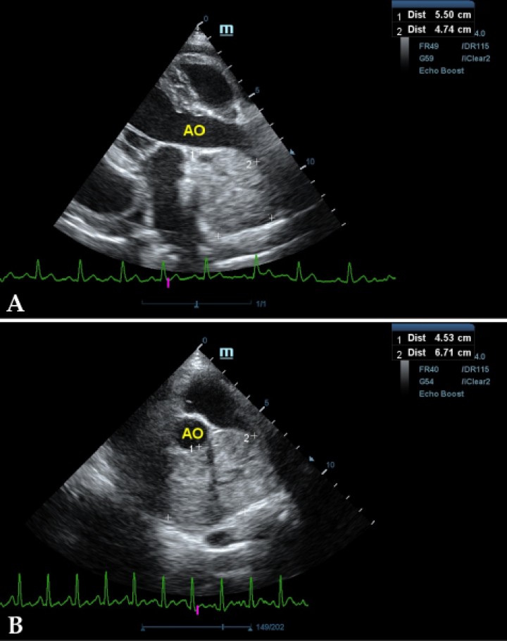 <p>Ecocardiografía en corte paraesternal izquierdo en base de corazón, en las que se observa la estructura hiperecoica y heterogénea junto a la aorta en un corte de la lesión transversal (<strong>A</strong>) y otro longitudinal (<strong>B</strong>). Compatible con neoplasia.</p>