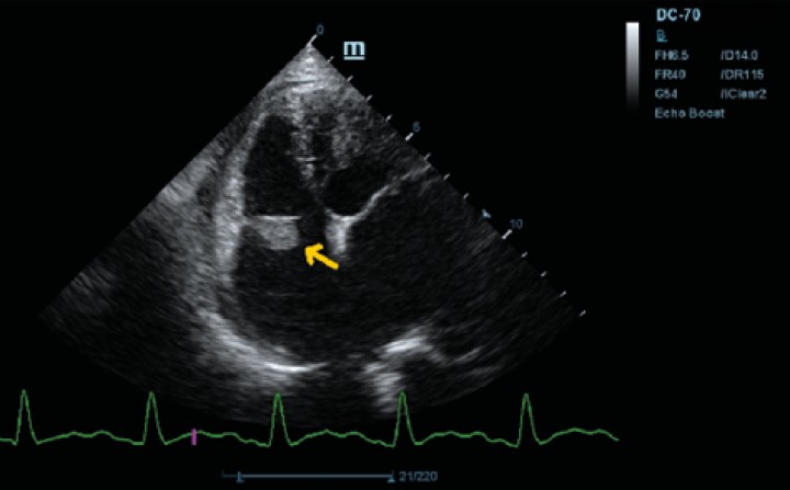 <p>Ecocardiografía en corte paraesternal izquierdo eje largo, optimizada para válvula tricúspide en la que se observa estructura hiperecoica.</p>
