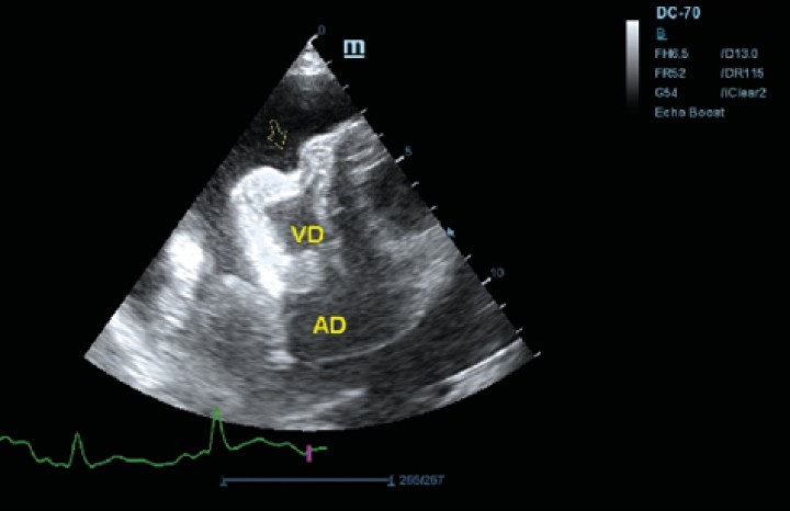 <p>Ecocardiografía en corte paraesternal izquierdo en eje largo optimizada para corazón derecho en la que se observa taponamiento cardiaco en ventrículo derecho (flecha) debido a derrame pericárdico.</p>