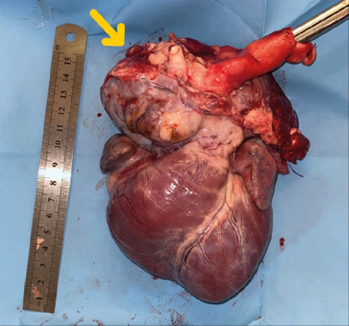 <p>Imagen de corazón evidenciando masa en base aórtica (flecha).</p>