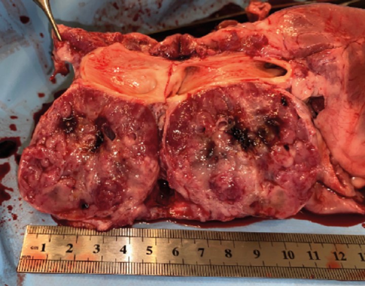 <p>Detalle de masa adherida a aorta. Masa esponjosa, cavitada, vascularizada, con áreas de necrosis y tejido adiposo.</p>