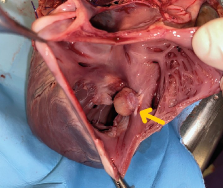 <p>Detalle de masa tricúspide (flecha). Visión desde aurícula derecha.</p>