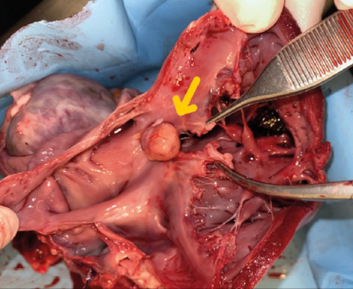 <p>Detalle de masa tricúspide (flecha) adherida a las valvas. Vista gracias a la apertura completa del ventrículo derecho.</p>