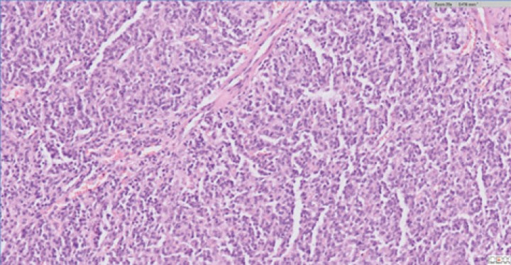 <p>Vista histopatológica de tumor neuroendocrino: Se observa una proliferación de células poligonales formando nidos y paquetes y también áreas de empalizada alrededor de pequeños vasos sanguíneos. Las células muestran bordes indefinidos, citoplasma escaso a moderado eosinófilo finamente granular, núcleo redondo, cromatina granular y nucléolo variablemente presente, pequeño, redondo y basófilo. La anisocitosis y anisocariosis son moderadas.</p>