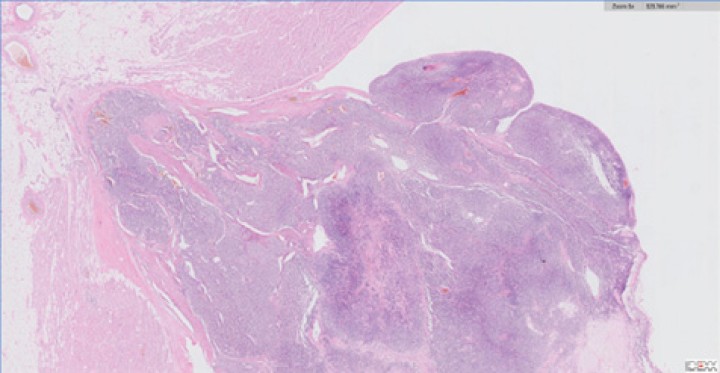 <p>Vista histopatológica de lesión tricúspide, infiltrando, expandiendo y obliterando la válvula tricúspide; en una de las secciones se observa un nódulo moderadamente delimitado, no encapsulado, expansivo y densamente celular que se extiende hacia la luz del ventrículo y atraviesa todo el miocardio hacia el tejido adiposo del epicardio. La masa muestra características similares a lo descrito para la proliferación previa, por lo que se considera metástasis de la primera.</p>