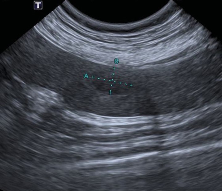 <p>Nódulo hipoecoico observado en el parénquima esplénico durante la realización de la ecografía abdominal.</p>