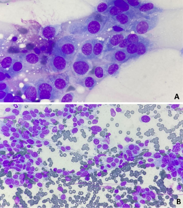 <p>Citologías de los aspirados realizados mediante ecografía tanto de la lesión mediastínica (<strong>A</strong> 100x) como del nódulo esplénico (<strong>B</strong> 40x) mediante tinción panóptica rápida (Wright modificado) caracterizadas por la presencia de una población de células no cohesivas fusiformes a estrelladas con hemofagocitosis y numerosos criterios de malignidad.</p>