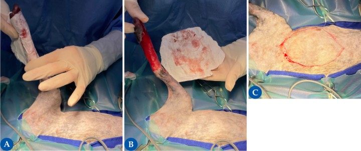 <p>Es muy importante seleccionar adecuadamente el área donante. Para obtener un buen resultado estético, idealmente el lugar donante debe tener el pelo del mismo color, textura, longitud y grosor al pelo circundante del lecho receptor. Además, el área donante debe tener la suficiente piel para permitir el cierre de la herida sin tensión tras la obtención del injerto. En este caso, se seleccionó la región torácica y abdominal lateral, uno de los lugares donantes más comunes. Esta presenta una piel delgada, abundante y con una buena cobertura de pelaje, ofreciendo buenos resultados estéticos y permitiendo una adecuada aposición con mínima morbilidad. Las figuras 2<strong>A</strong> y 2<strong>B</strong> reflejan un ejemplo de cómo estimar la cantidad de tejido que se necesita reseccionar para el injerto. Se toma un trozo de papel, en este caso el envoltorio estéril de los guantes quirúrgicos, y se posiciona alrededor del defecto, dejando una impronta de sangre en el papel; el papel luego se recorta alrededor de la zona “marcada” y se coloca en la zona donante, usándose como patrón para el corte de piel (2<strong>C</strong>).</p>