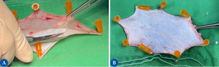 <p>Una vez obtenido el injerto, este debe mantenerse tenso y firme para facilitar la adecuada resección del tejido subcutáneo (SC). La figura 3<strong>A</strong> muestra el injerto obtenido, el cual es inmovilizado mediante la aplicación de agujas hipodérmicas estériles en los bordes del injerto. Para la preparación del injerto, se debe reseccionar todo el tejido SC y la grasa, preservando los folículos pilosos (3<strong>B</strong>) para favorecer un adecuado crecimiento del pelo y mantener una estética adecuada. Es importante que cuando coloquemos el injerto en la zona receptora, recordemos la dirección del crecimiento del pelo. Una manera de garantizarlo es colocando una sutura en uno de los extremos (asterisco). En nuestro caso, la sutura está en la zona caudal del injerto, misma dirección hacia la que crece el pelo en esta zona.</p>