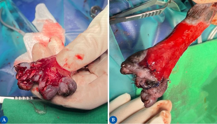 <p>El lecho receptor debe ser capaz de proporcionar una adecuada vascularización al injerto. Por ello, los injertos deben ser colocados sobre un adecuado tejido de granulación, libre de infección y detritos, que permitan una conexión de las arterias y venas del lecho receptor al tejido donante. Los injertos pueden fracasar si se colocan sobre tejidos crónicos, lechos con grasa avascular, sobre tejidos de granulación hipertróficos, hueso, cartílago, tendón o nervio. En la figura 4<strong>A</strong> se observa la epífisis distal de los metacarpianos 3 y 4 demostrando una luxación metacarpo-falángica de ambos. Los restos de ligamentos dorsales han sido reseccionados, ya que no eran funcionales. La parte de metacarpiano expuesta se ostectomiza y se amputan las falanges proximal, media y distal de ambos dedos, preservando la piel y las almohadillas. En la figura 4<strong>B</strong> se muestra la reconstrucción del área mediante la técnica llamada <em>“Phalangeal fillet”</em> que consiste en la preservación de las almohadillas digitales sobre un pedículo cutáneo vascularizado que servirá de protección durante el apoyo de la extremidad del área ausente de metacarpianos, metatarsianos (como en este caso) o falanges.</p>